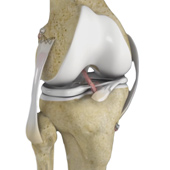 Knee Multi Ligament Injury Management