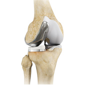 Lateral Unicompartmental Knee Replacement