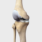 Medial Unicompartmental Knee Replacement