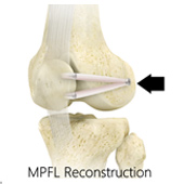 MPFL Reconstruction