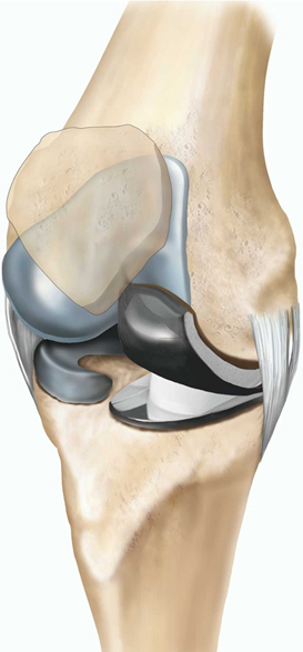 unicompartmental-knee-replacement